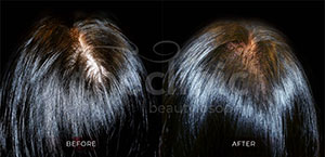 Hair Growth Factor Therapy